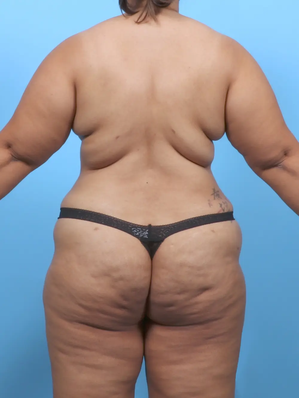 Breast Lift/Reduction w/o Implants Patient Photo - Case 51749 - after view-3