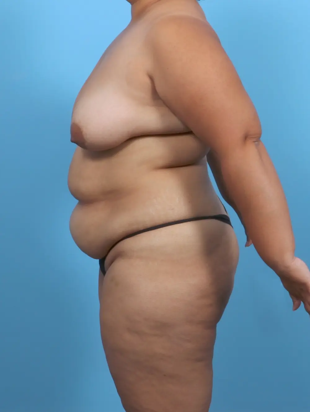 Breast Lift/Reduction w/o Implants Patient Photo - Case 51749 - before view-2