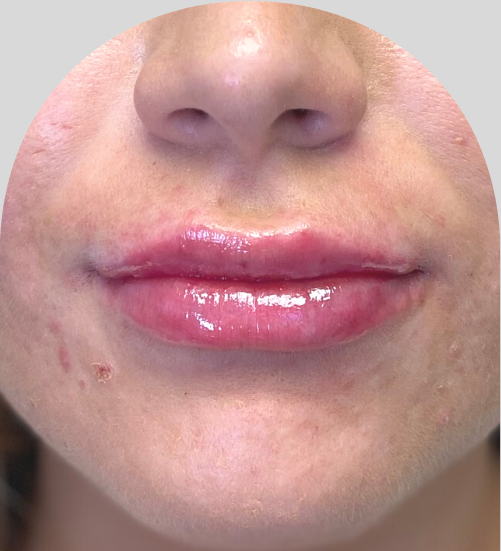Lip Fillers - Case 51901 - After