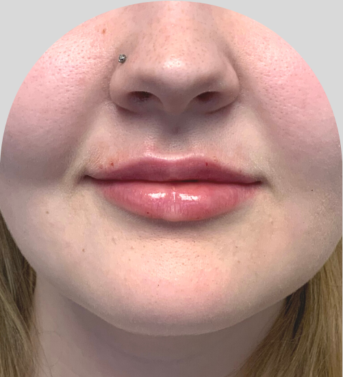 Lip Fillers - Case 51905 - After