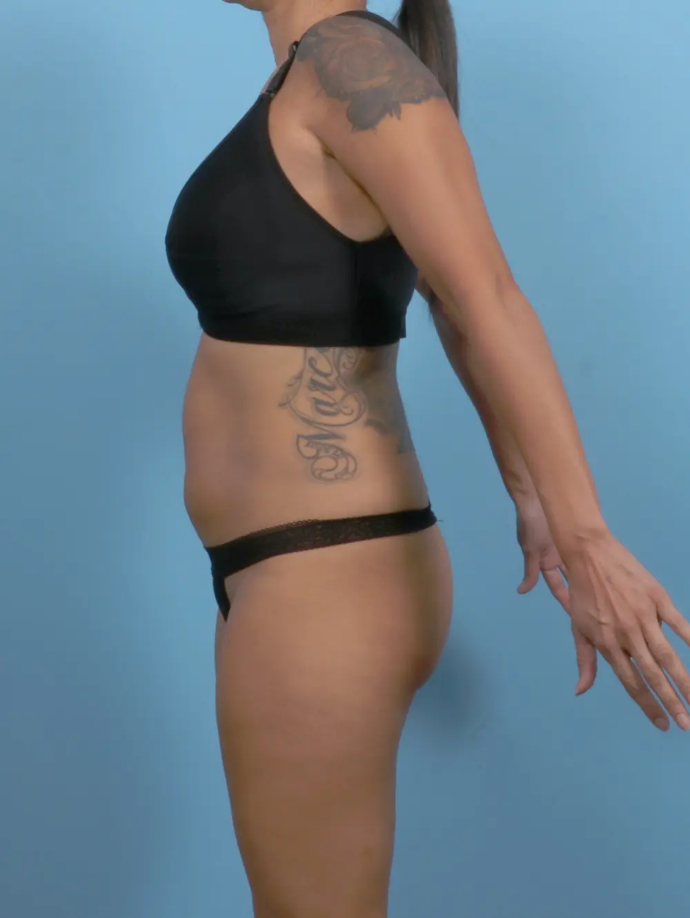 Tummy Tuck Patient Photo - Case 52027 - before view-2