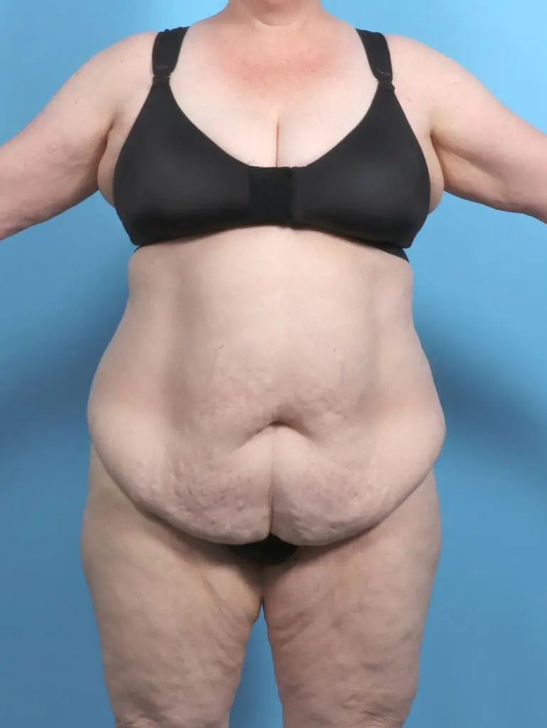 Tummy Tuck - Case 52047 - Before