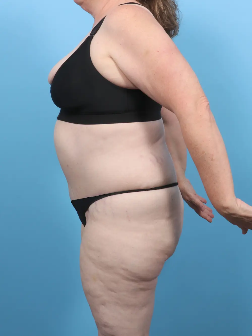 Tummy Tuck Patient Photo - Case 52047 - after view-2