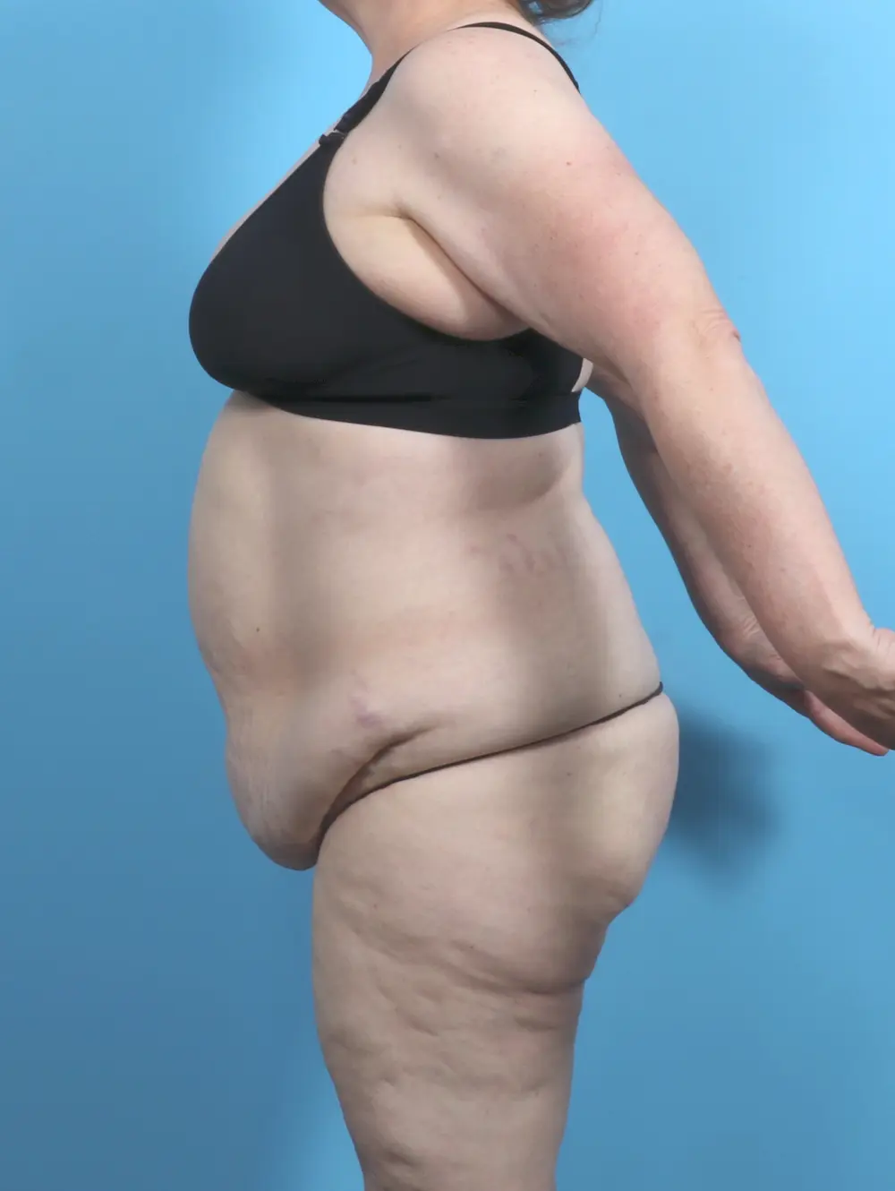 Tummy Tuck Patient Photo - Case 52047 - before view-2