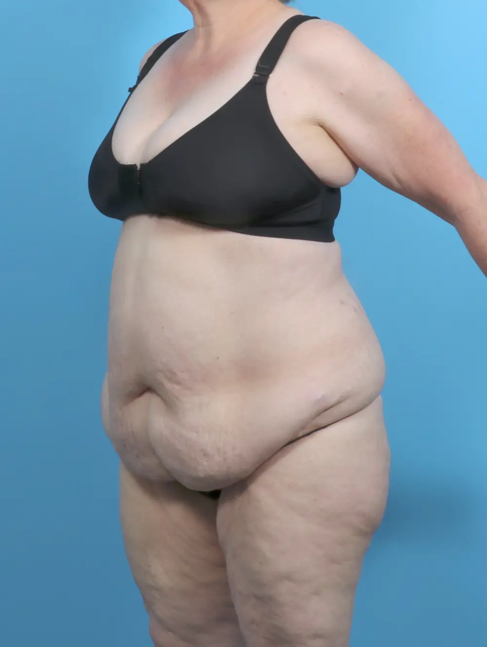 Tummy Tuck Patient Photo - Case 52047 - before view-1