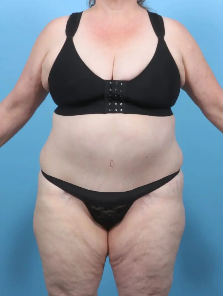 Tummy Tuck - Case 52047 - After