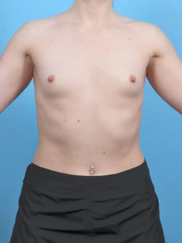 Breast Augmentation - Case 52055 - Before