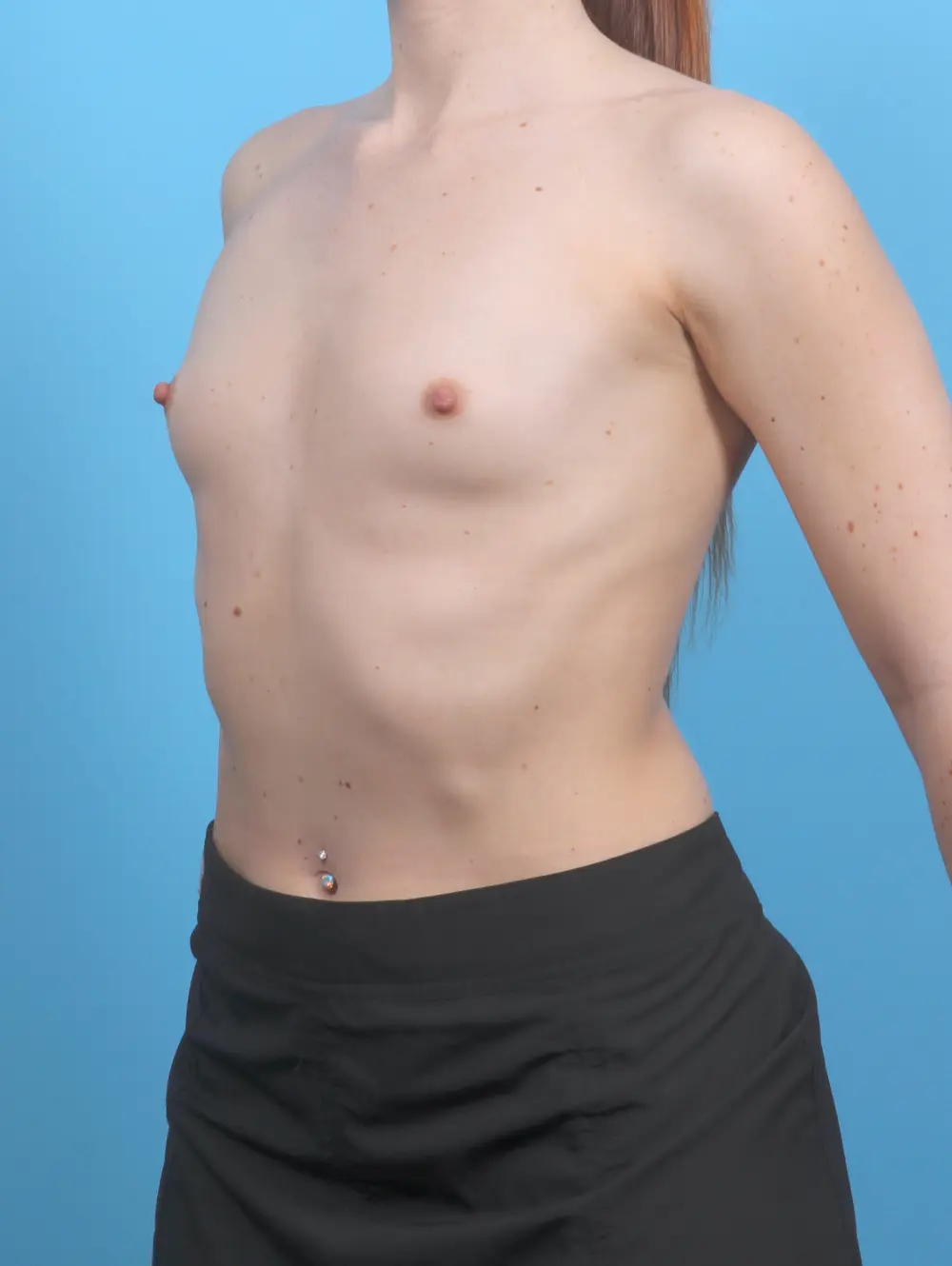 Breast Augmentation Patient Photo - Case 52055 - before view-1