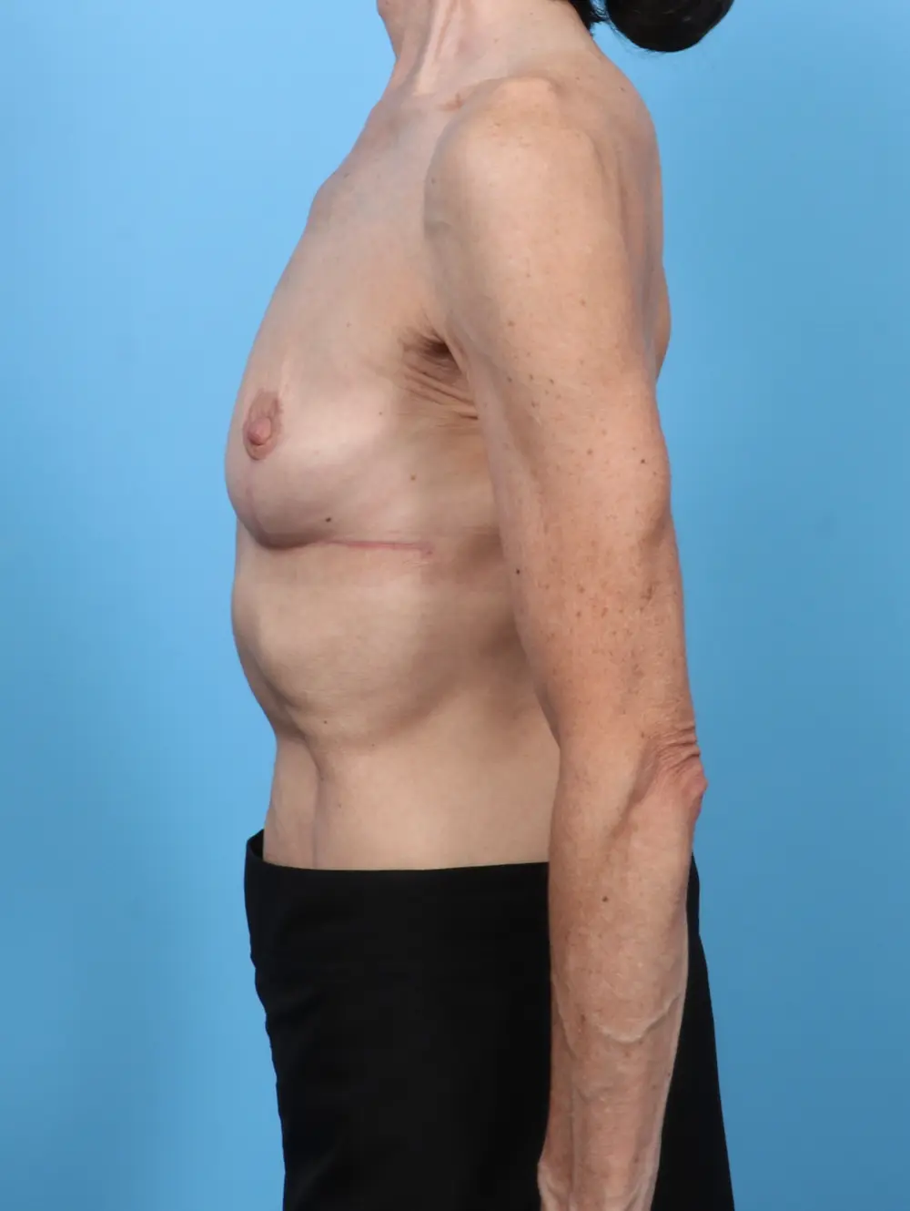 Breast Implant Removal Patient Photo - Case 52071 - after view-2