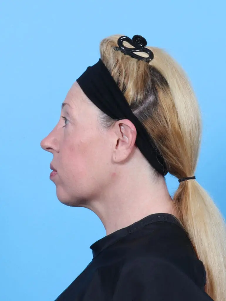 Rhinoplasty - Case 52100 - After