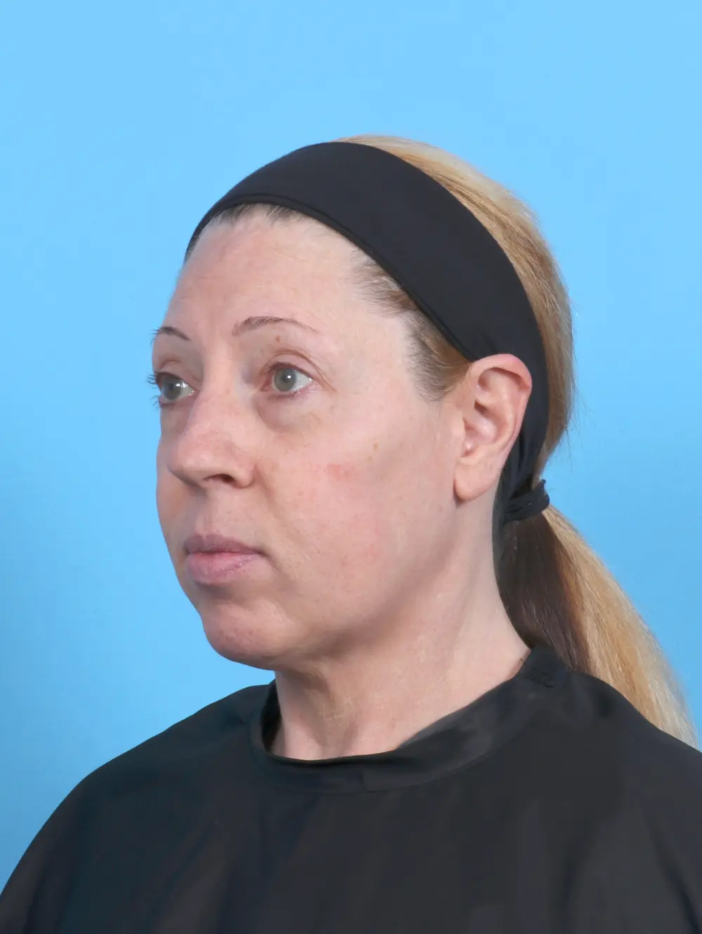 Rhinoplasty Patient Photo - Case 52100 - before view-1