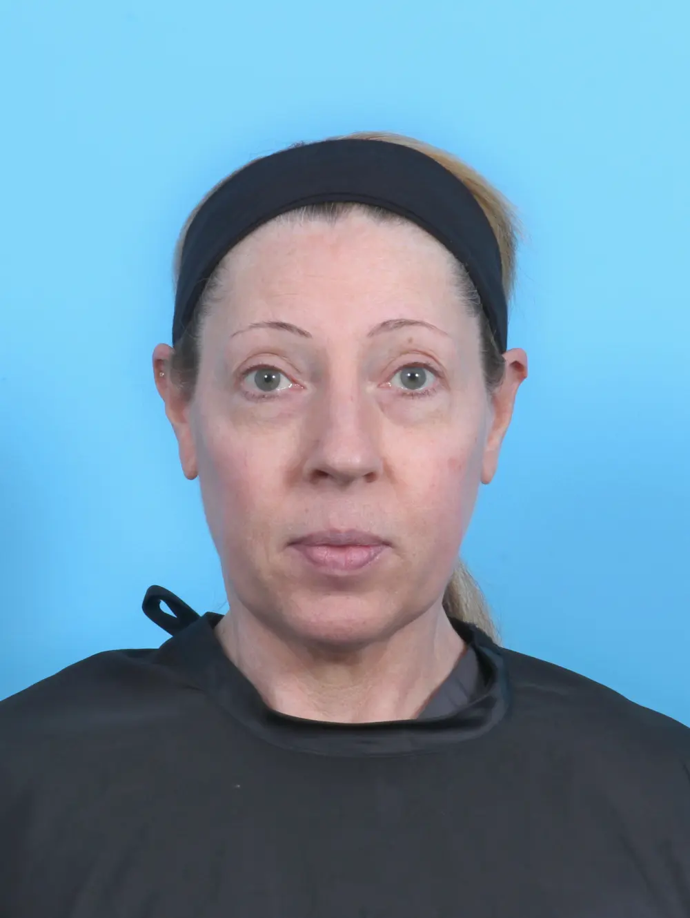 Rhinoplasty Patient Photo - Case 52100 - before view-2