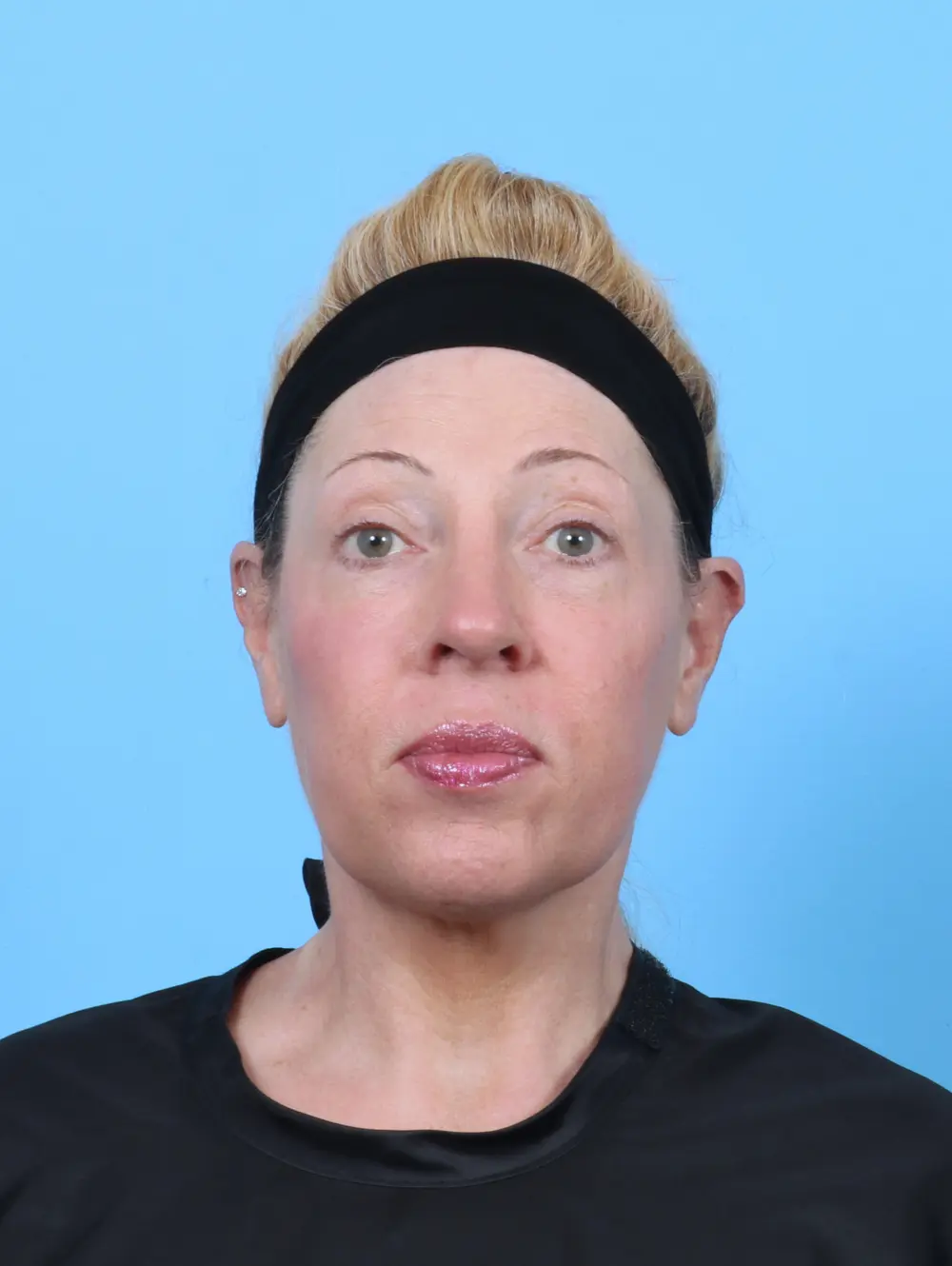 Rhinoplasty Patient Photo - Case 52100 - after view-2