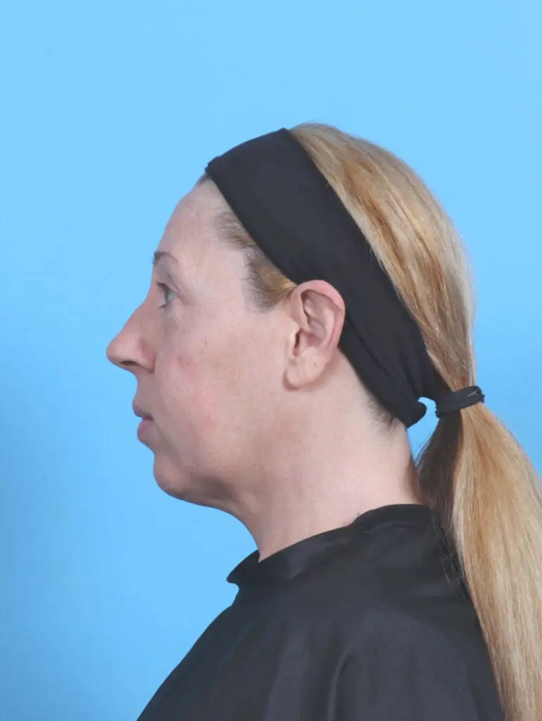 Rhinoplasty - Case 52100 - Before