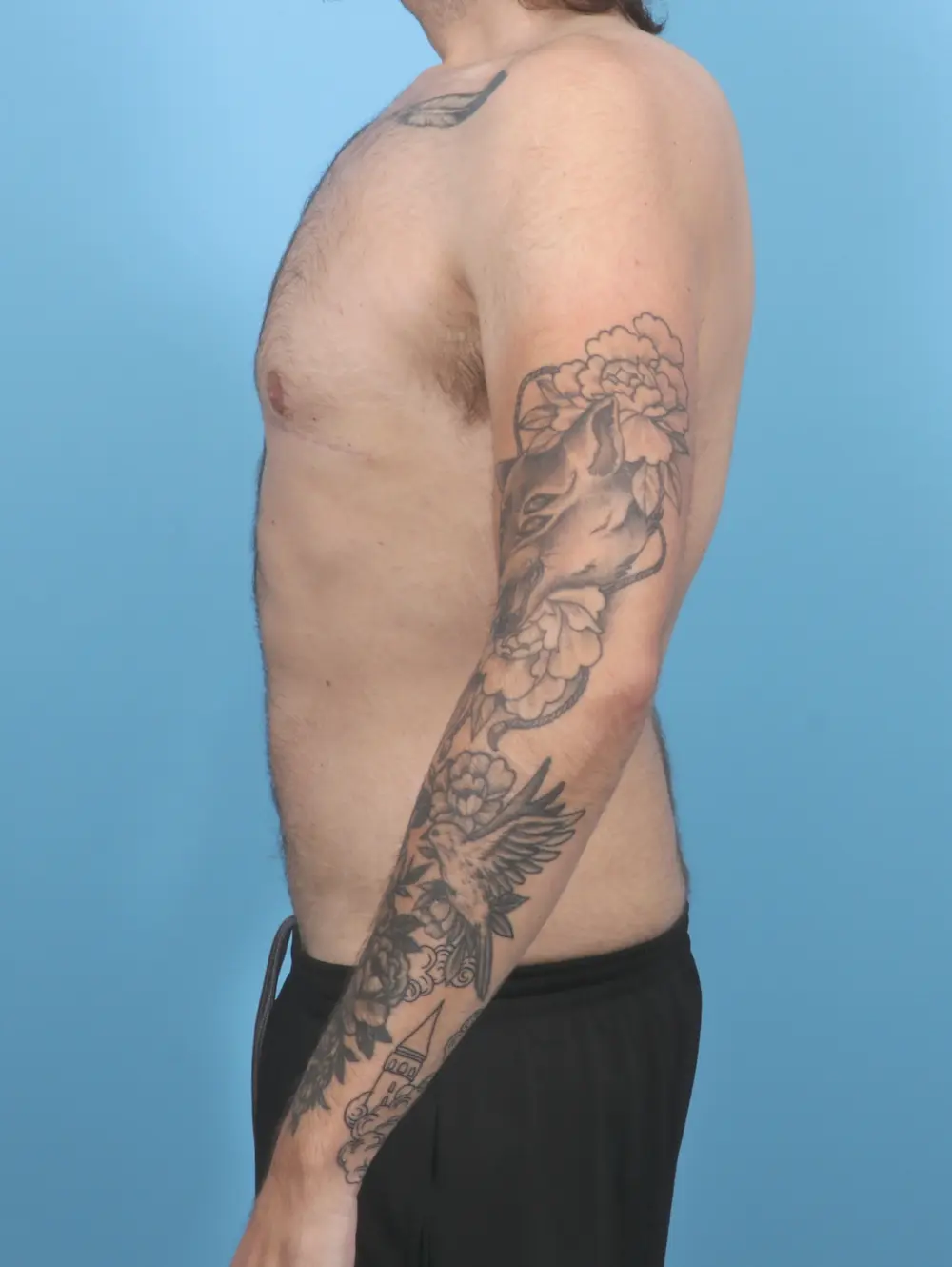 Gynecomastia Patient Photo - Case 52126 - after view-2