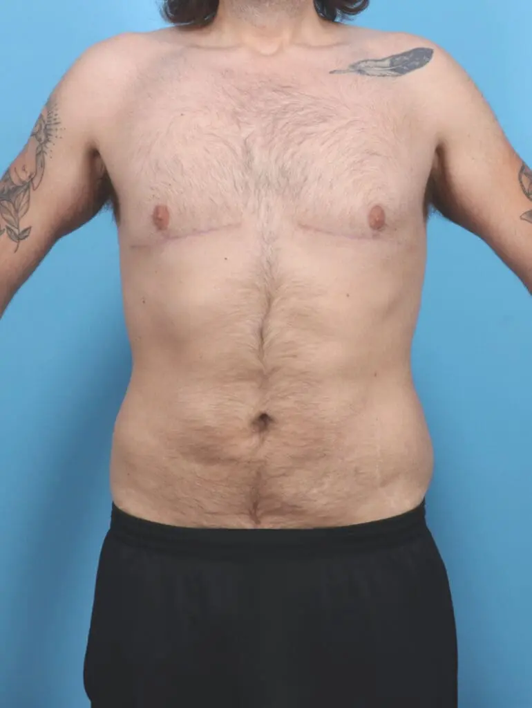 Gynecomastia - Case 52126 - After