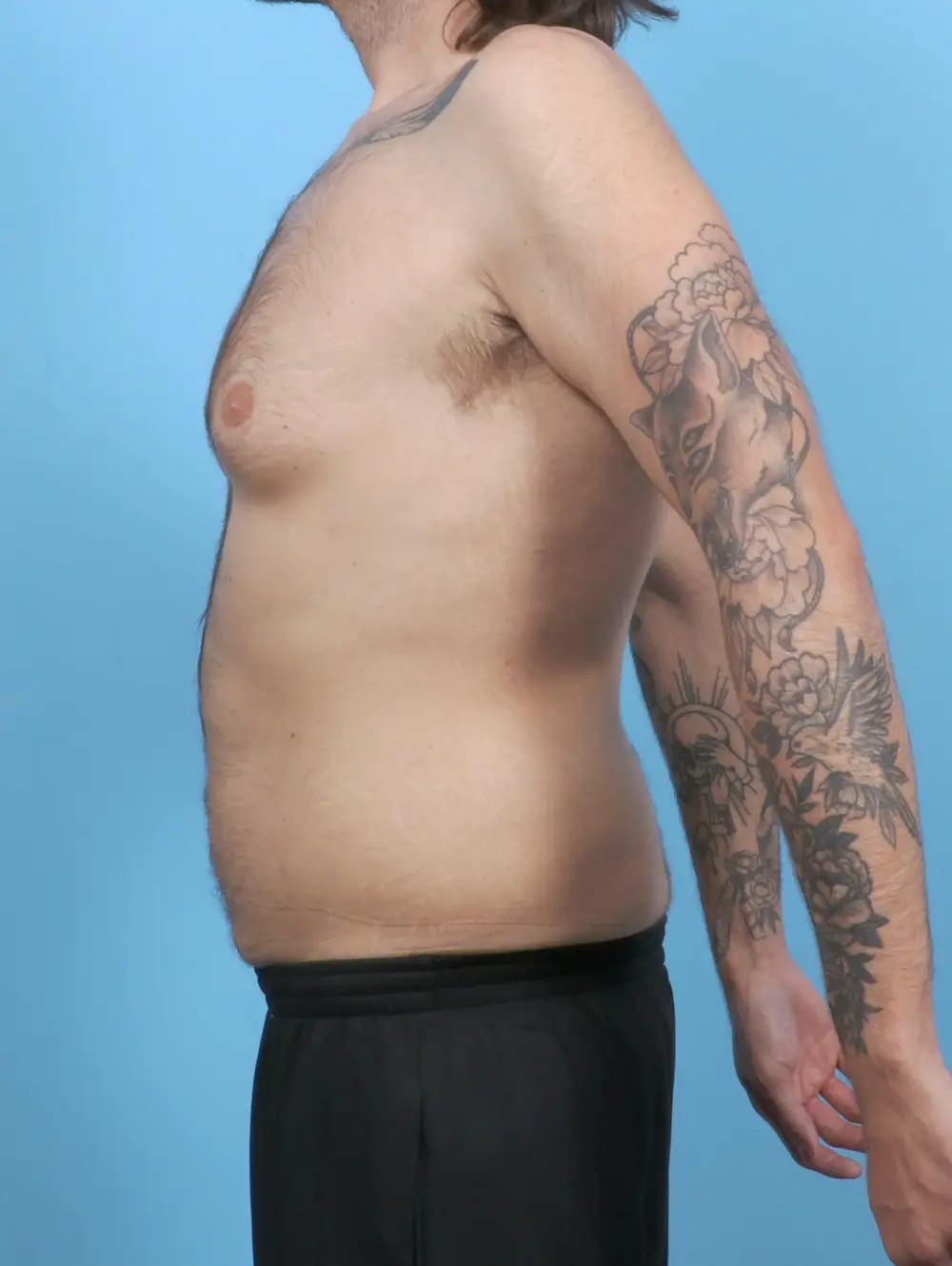 Gynecomastia Patient Photo - Case 52126 - before view-2