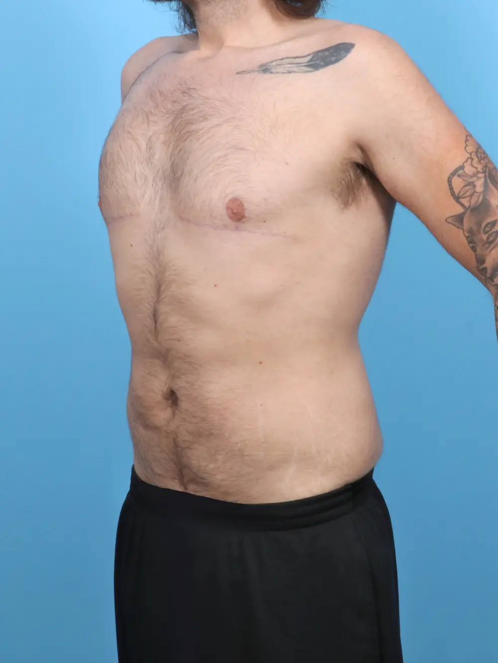 Gynecomastia Patient Photo - Case 52126 - after view-1