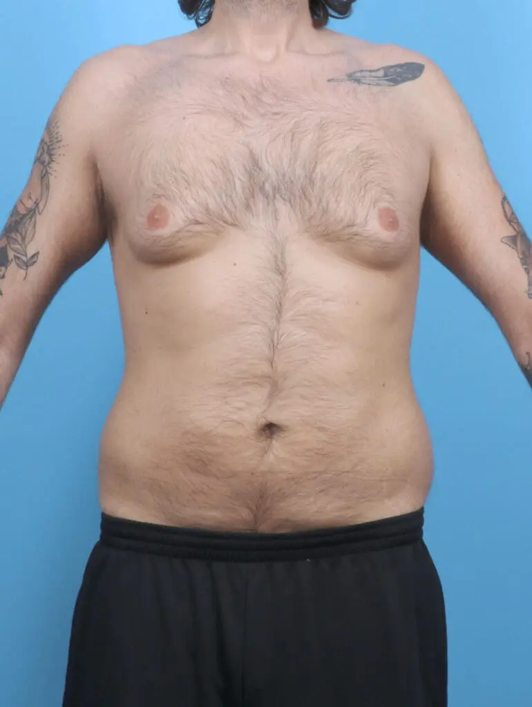 Gynecomastia - Case 52126 - Before