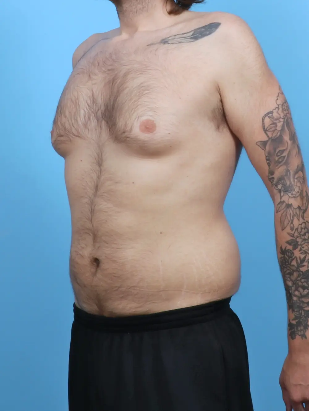 Gynecomastia Patient Photo - Case 52126 - before view-1