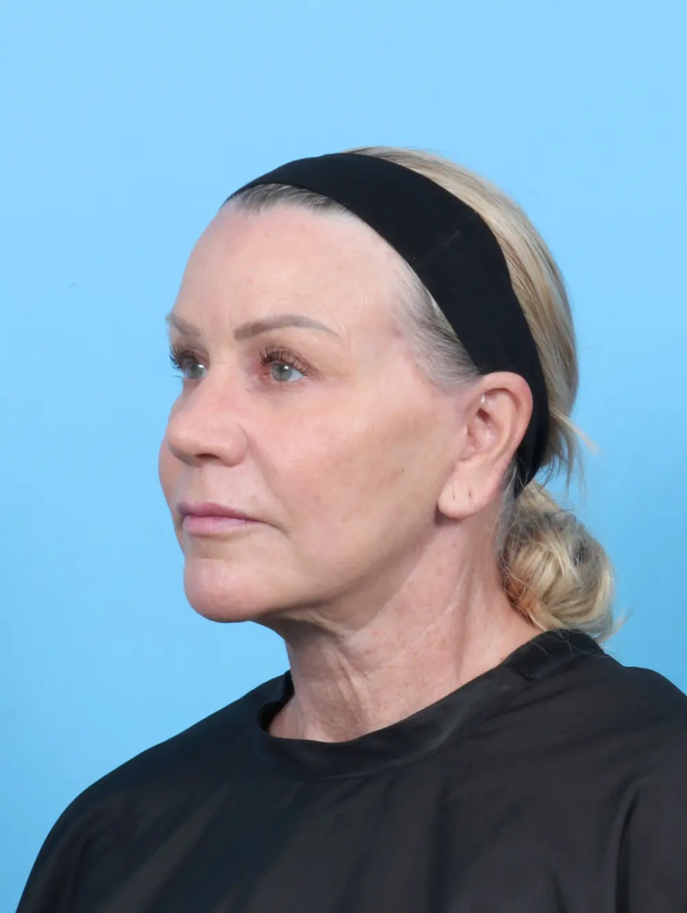 Facelift / Neck Lift Patient Photo - Case 52136 - after view-1