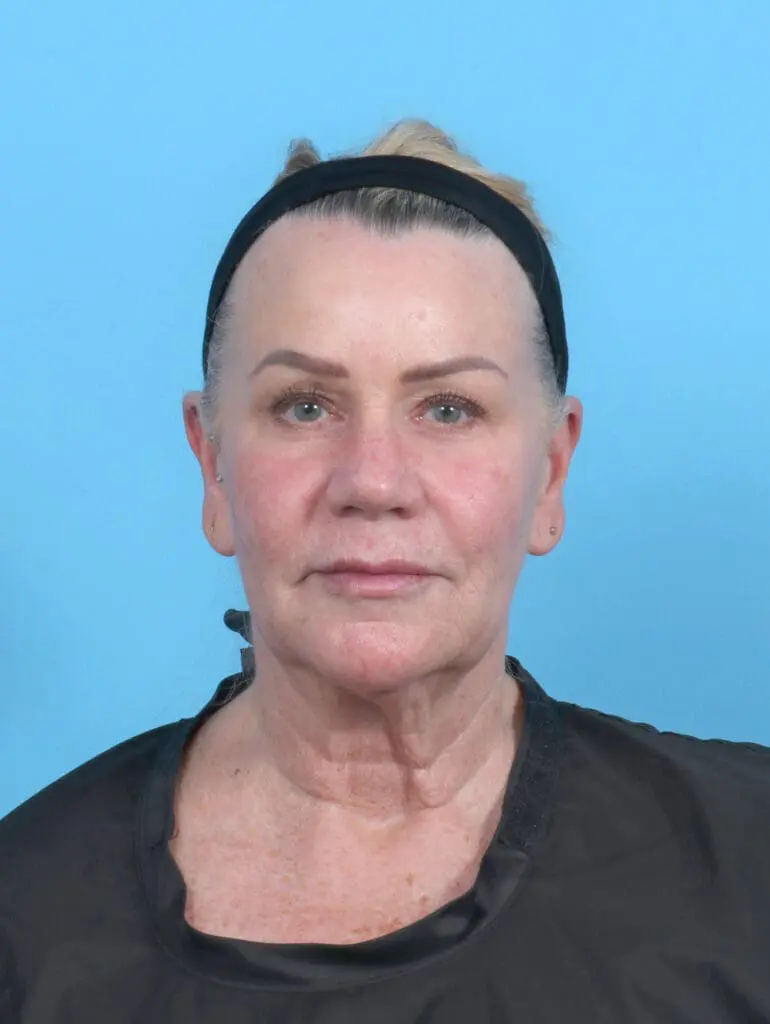 Facelift / Neck Lift - Case 52136 - Before