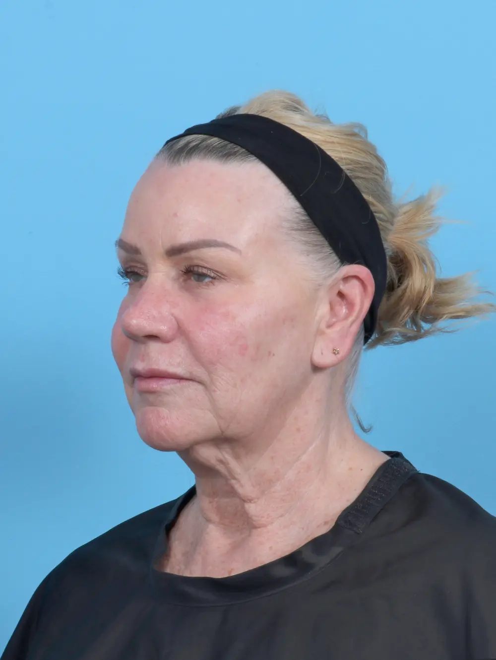 Facelift / Neck Lift Patient Photo - Case 52136 - before view-1