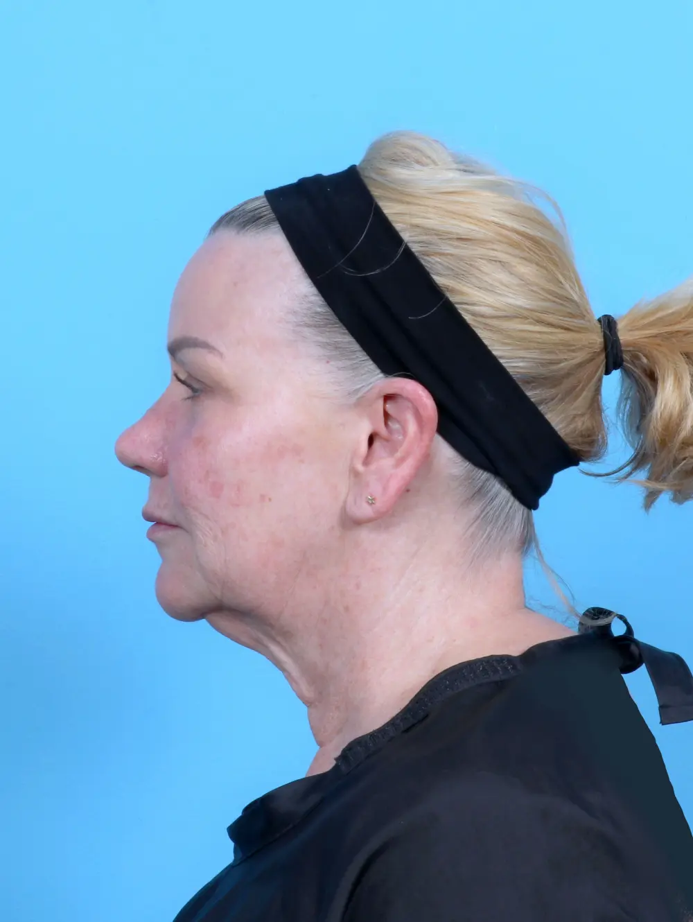 Facelift / Neck Lift Patient Photo - Case 52136 - before view-2