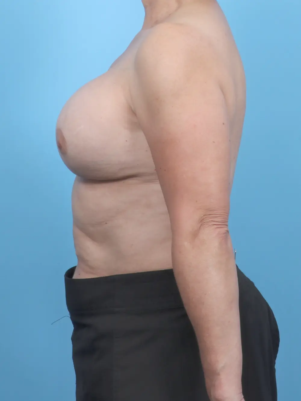 Breast Implant Revision Patient Photo - Case 52144 - after view-2
