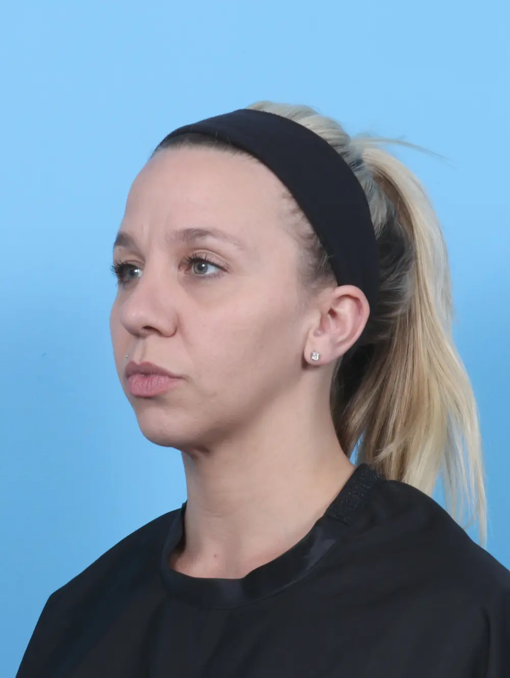 Rhinoplasty Patient Photo - Case 52161 - after view-1