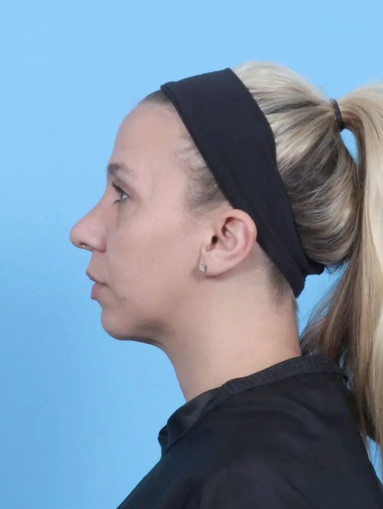 Rhinoplasty - Case 52161 - After