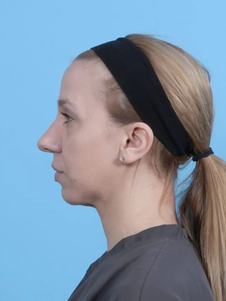 Rhinoplasty - Case 52161 - Before