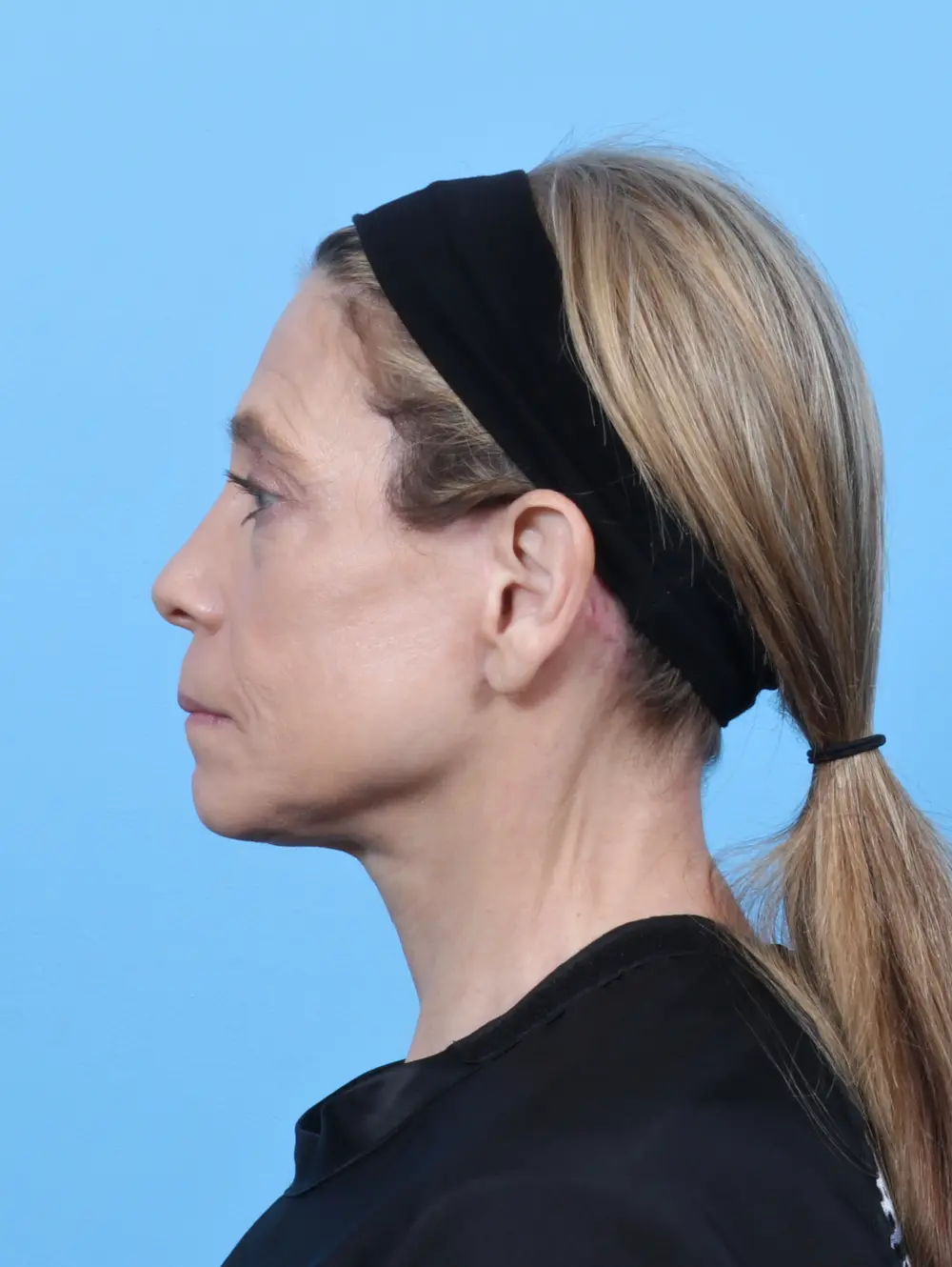 Facelift / Neck Lift Patient Photo - Case 52200 - after view-2