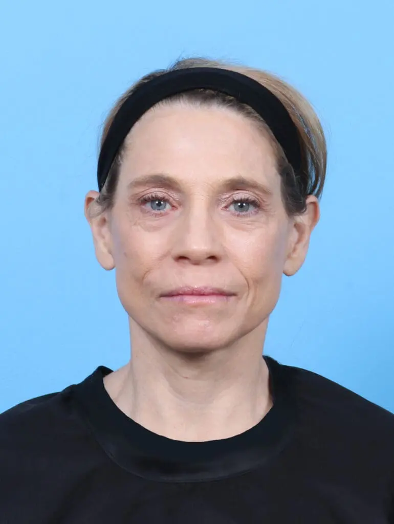 Facelift / Neck Lift - Case 52200 - After