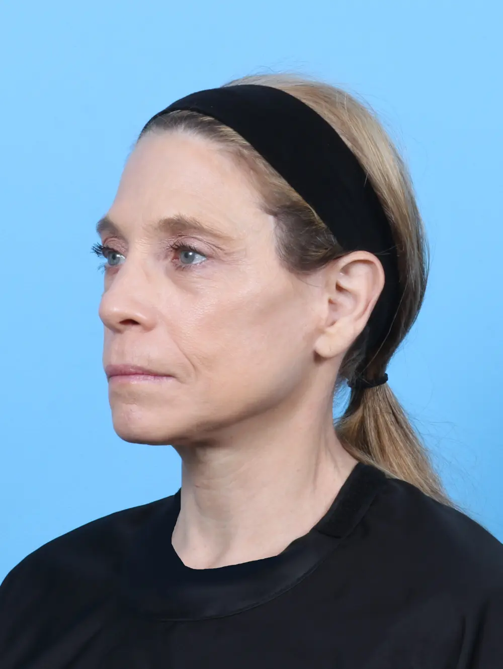 Facelift / Neck Lift Patient Photo - Case 52200 - after view-1