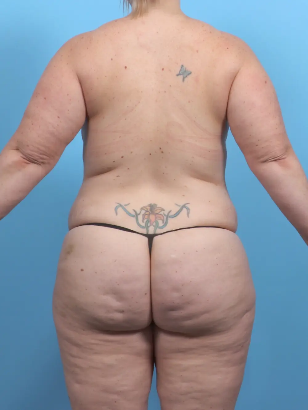 Breast Lift/Reduction with Implants Patient Photo - Case 52208 - before view-3