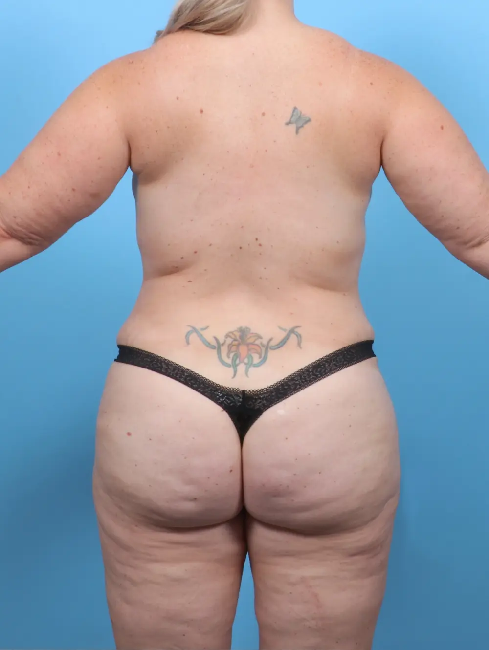 Breast Lift/Reduction with Implants Patient Photo - Case 52208 - after view-3