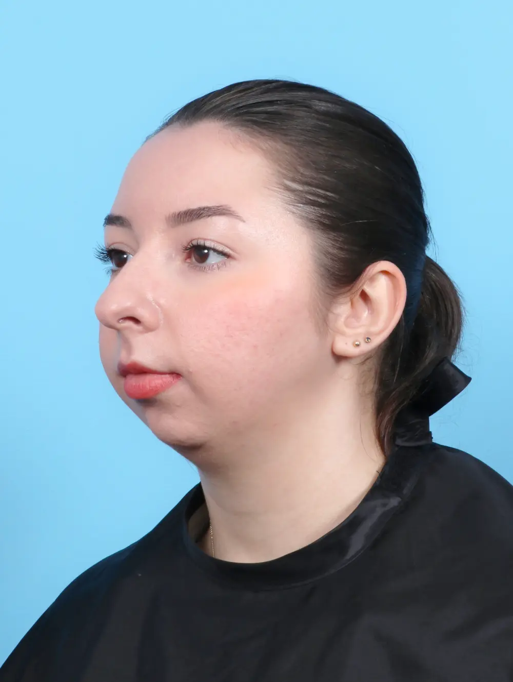 Chin Implant Patient Photo - Case 52247 - before view-1