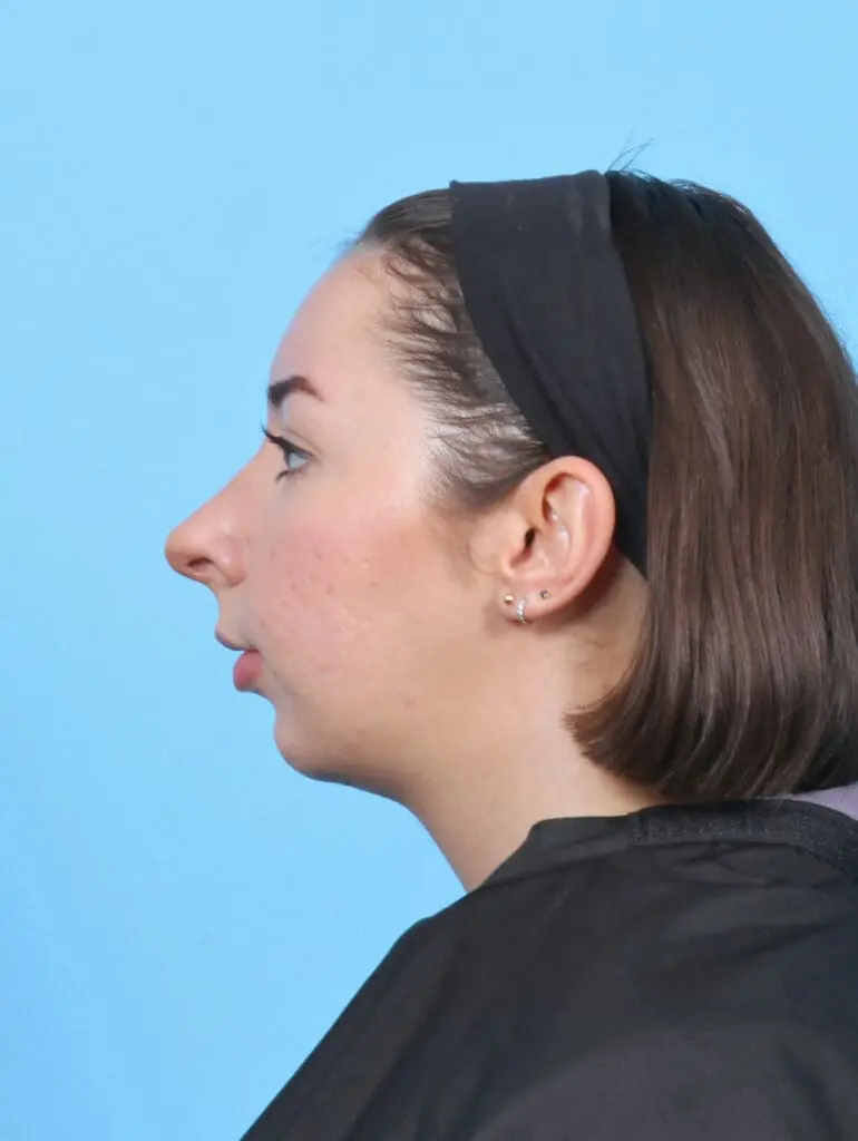 Chin Implant - Case 52247 - After