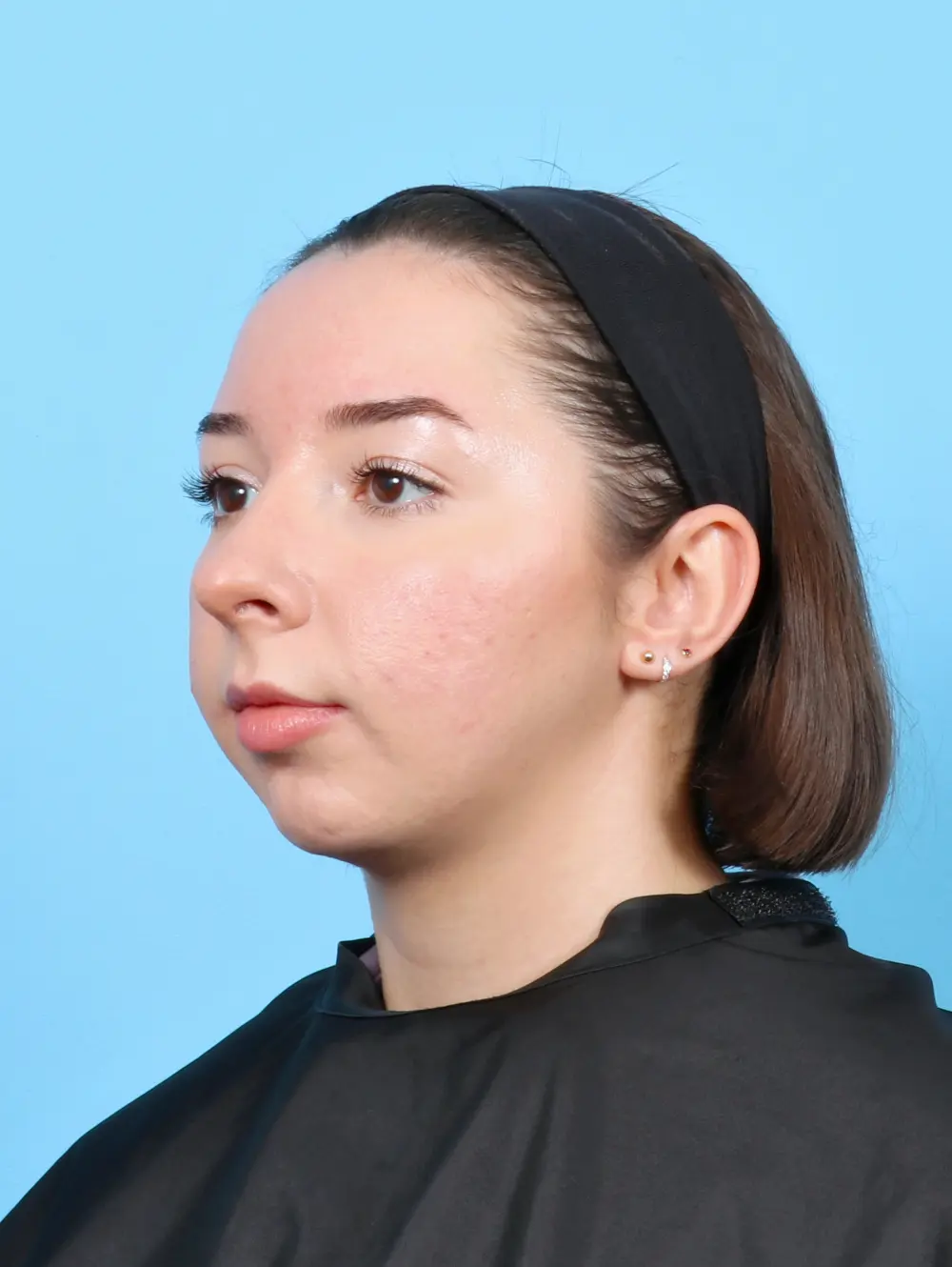 Chin Implant Patient Photo - Case 52247 - after view-1