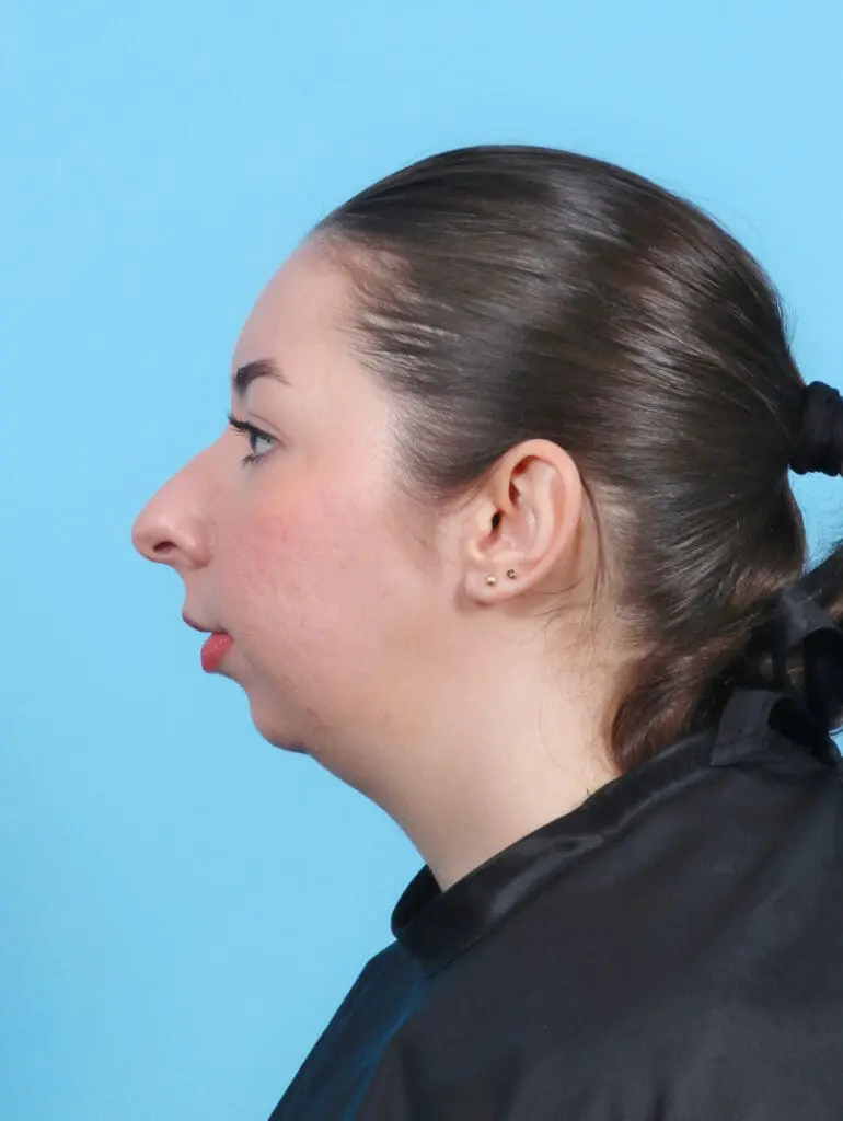 Chin Implant - Case 52247 - Before