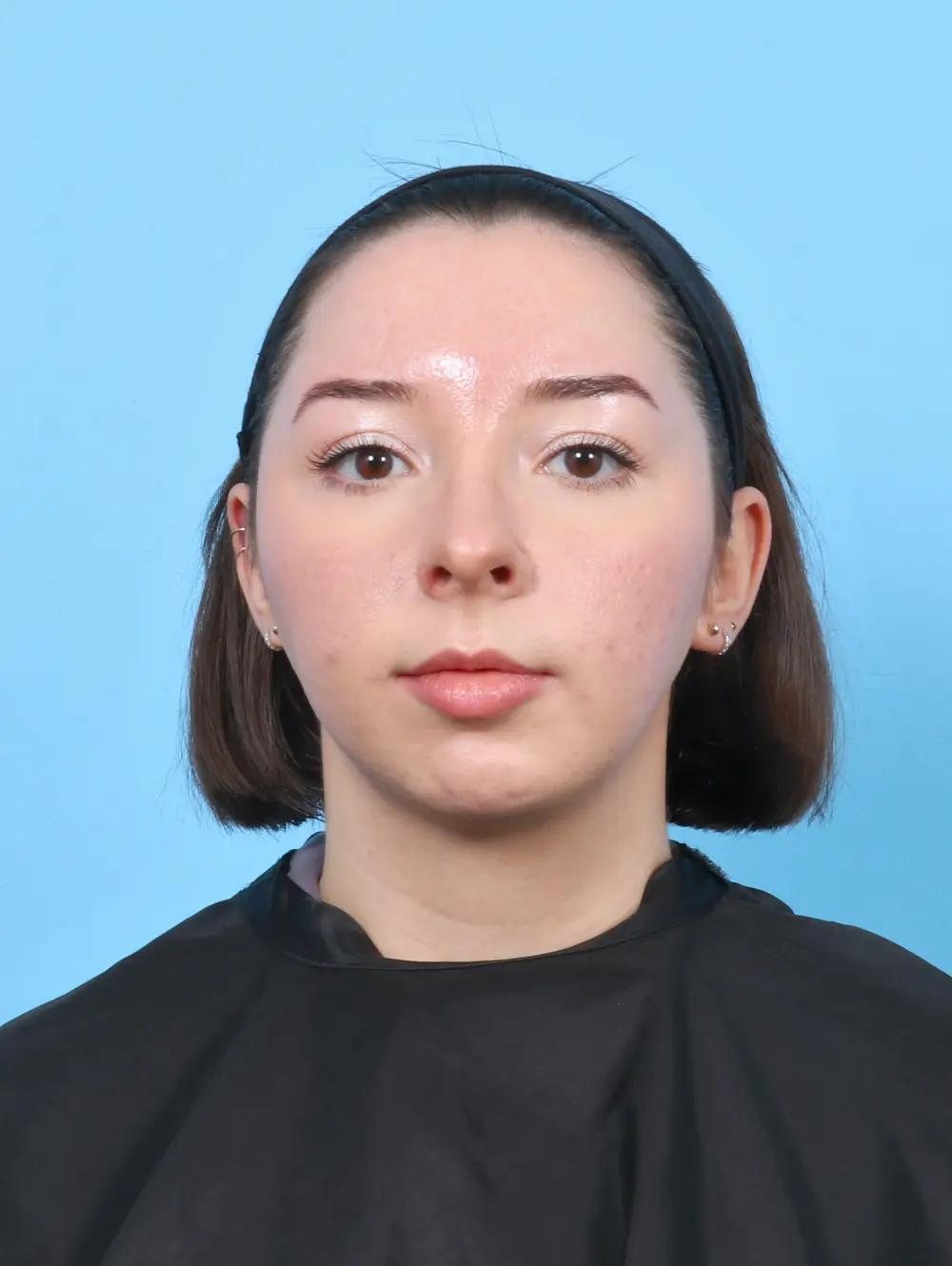 Chin Implant Patient Photo - Case 52247 - after view-2