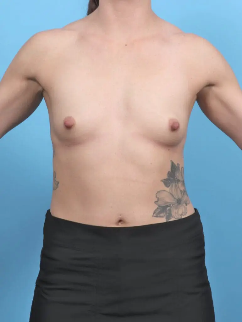 Breast Augmentation - Case 52256 - Before