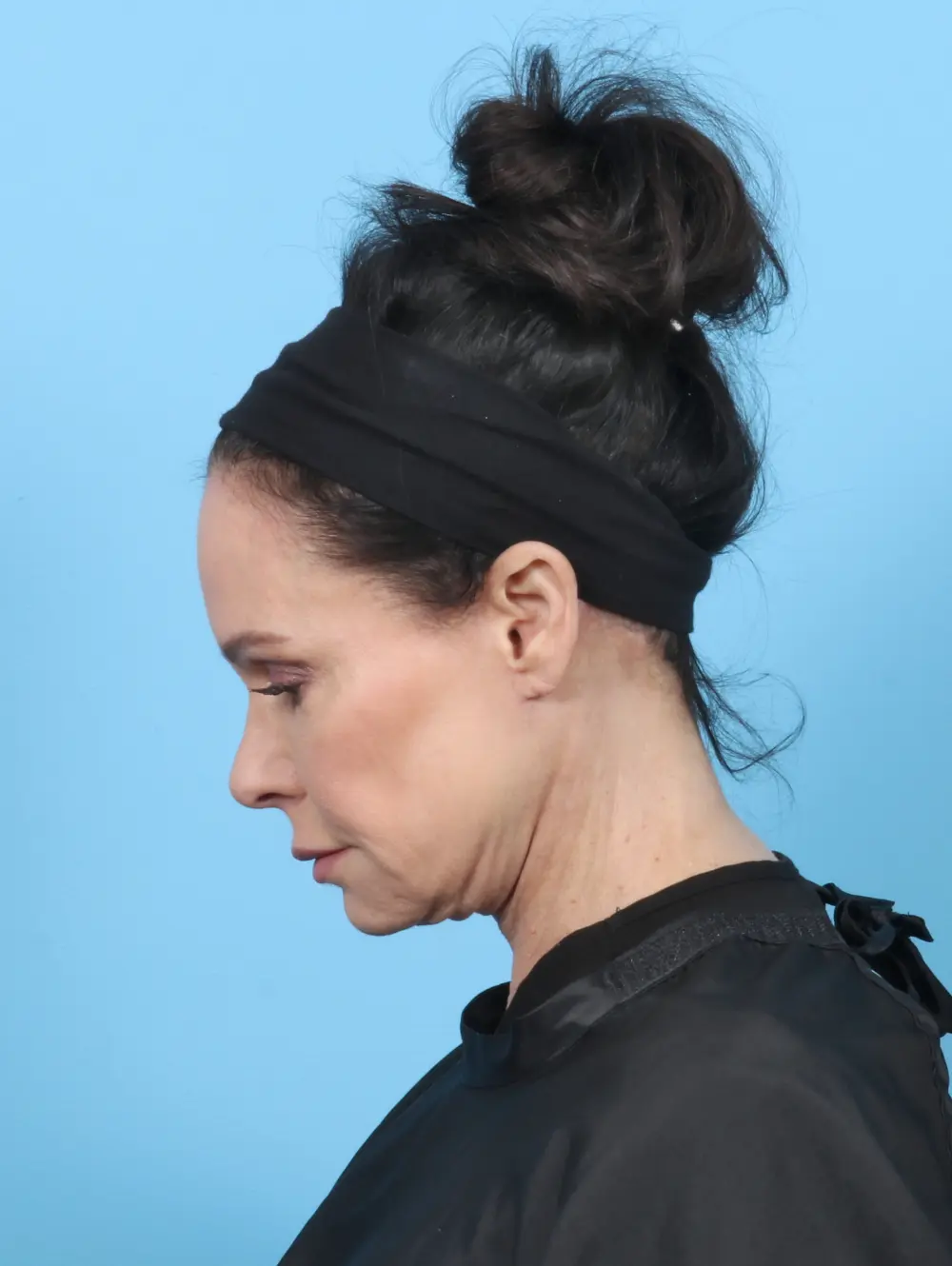 Facelift / Neck Lift Patient Photo - Case 52288 - after view-3