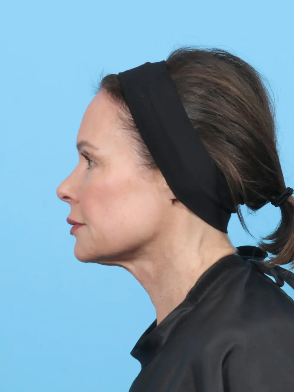 Facelift / Neck Lift Patient Photo - Case 52288 - before view-2