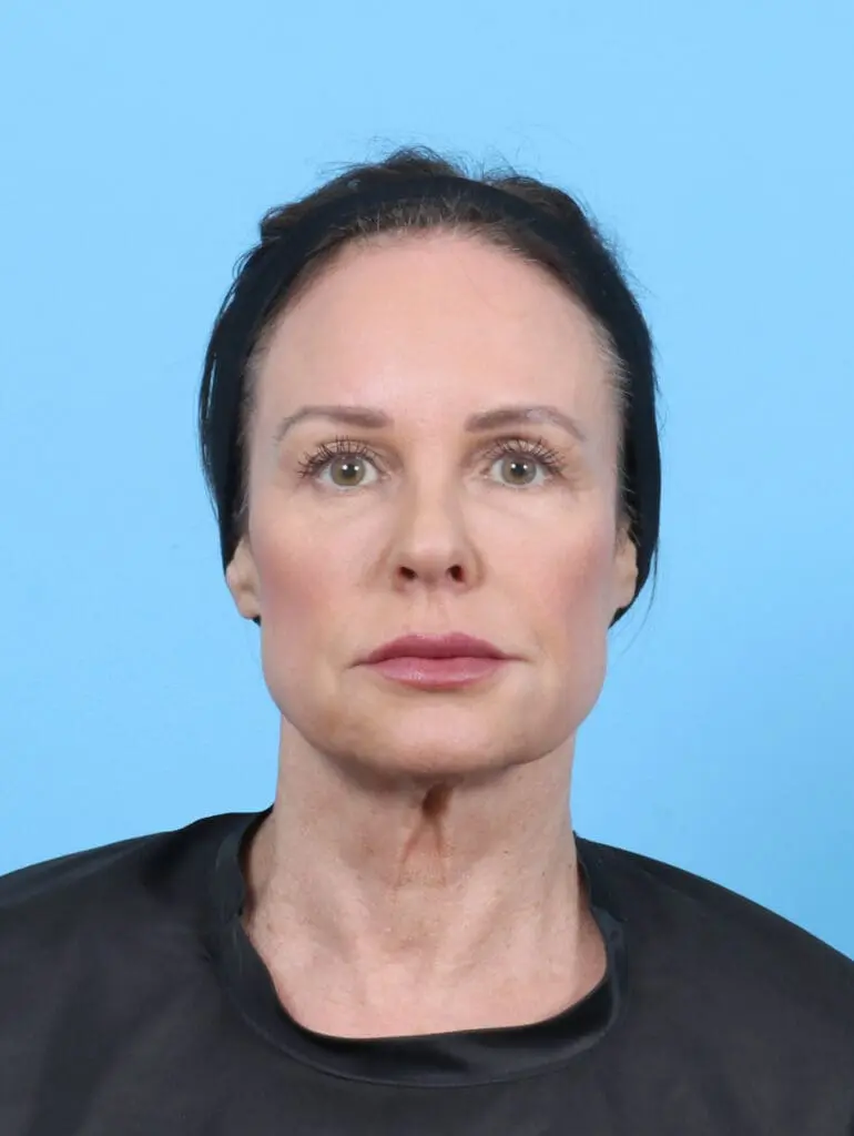 Facelift / Neck Lift - Case 52288 - Before
