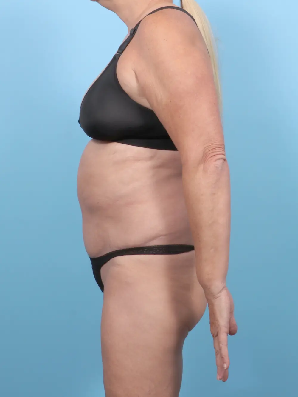 Tummy Tuck Patient Photo - Case 52320 - after view-2