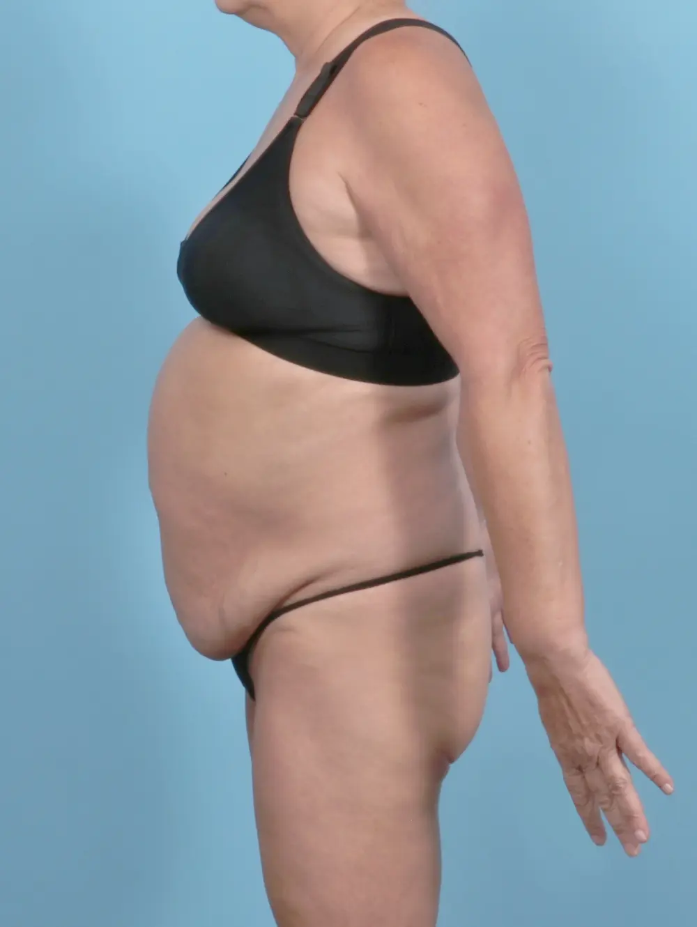 Tummy Tuck Patient Photo - Case 52320 - before view-2