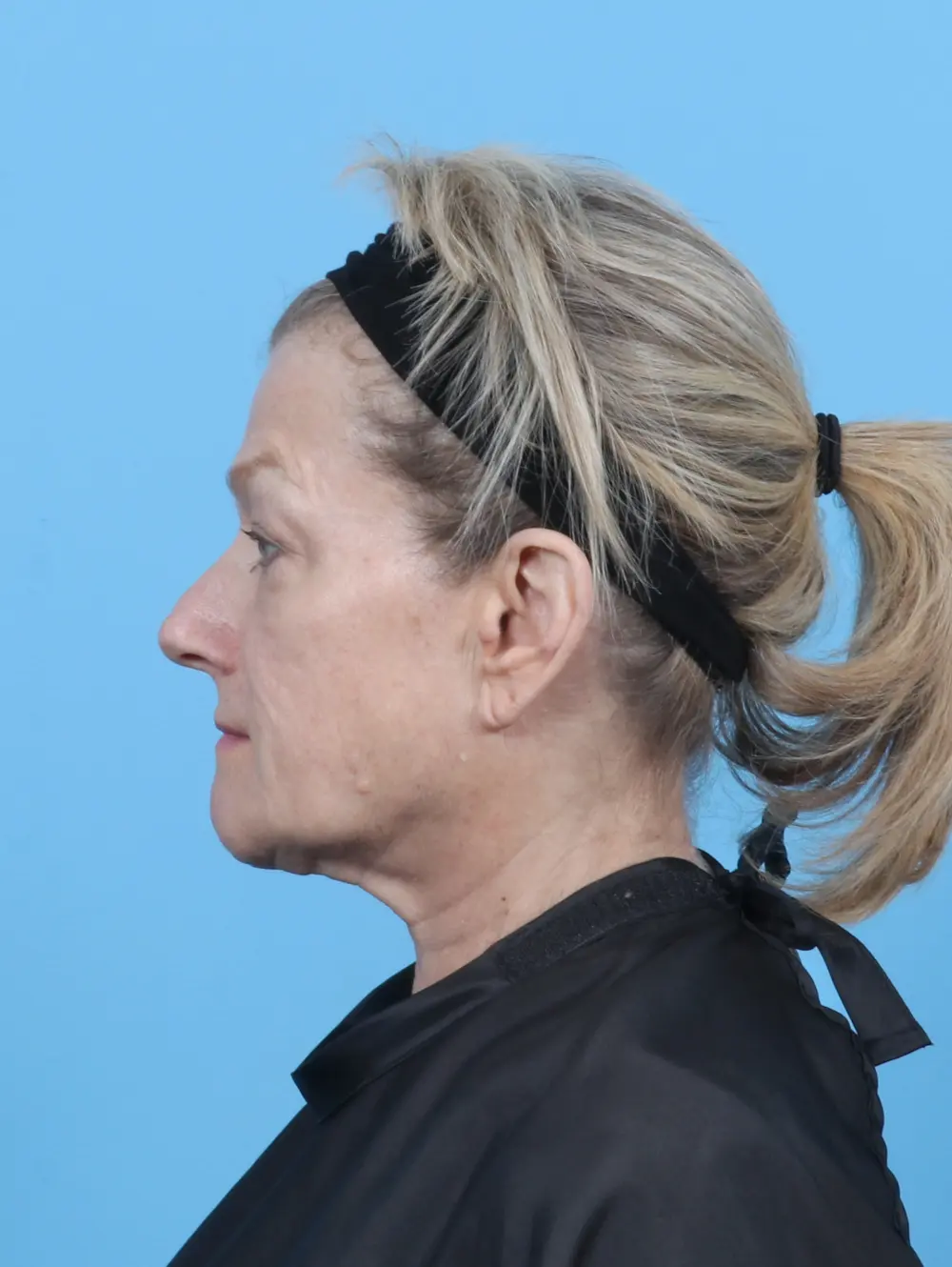 Eyelid Surgery Patient Photo - Case 52328 - before view-2