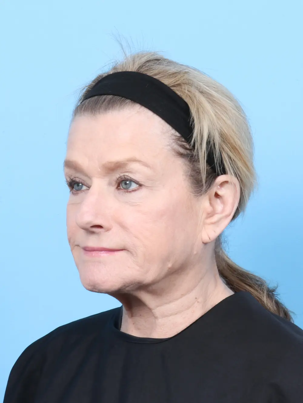 Eyelid Surgery Patient Photo - Case 52328 - after view-1